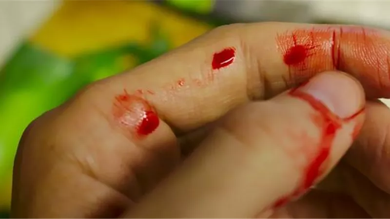  أسباب نزيف الدم بعد الإصابة .. «الدورة الدموية مواسير مقفولة» (فيديو)