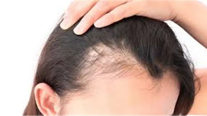 علاج تساقط الشعر (فيديو)
