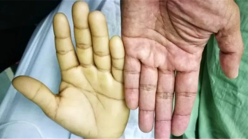  أعراض الأنيميا.. «شحوب وتغير في الأظافر»(فيديو)