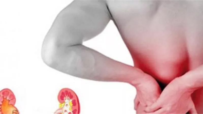  أعراض الحصوات على الكلى.. تغير لون البول وألم بالظهر» (فيديو)