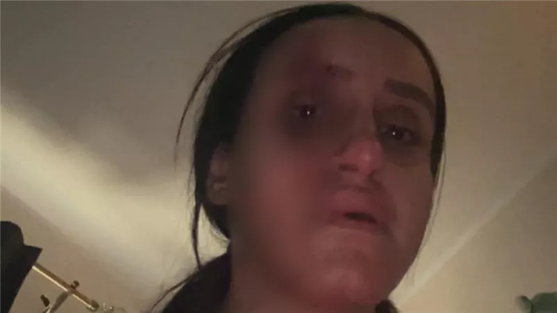  سحل وشرائح ومسامير.. ضحية زوجها بالبراجيل تكشف تفاصيل صادمة لـ17 سنة من العنف