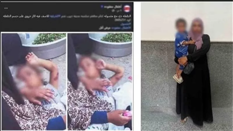 تفاصيل القبض على المتهمة باستغلال ابنتها المصابة بحروق في أعمال التسول بالشرقية 