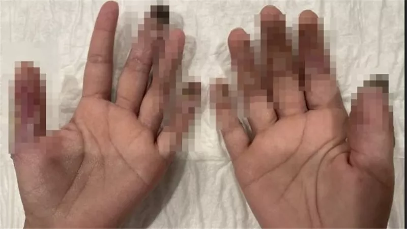 تفاصيل بتر عقلة إصبع بائعة بعد عضها من سيدة إريترية في الدقي