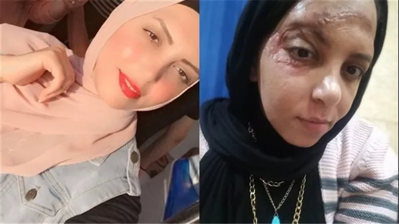 فتاة برج العرب ضحية الدهس تطالب بالقبض على المتهم وتنفيذ حكم حبسه