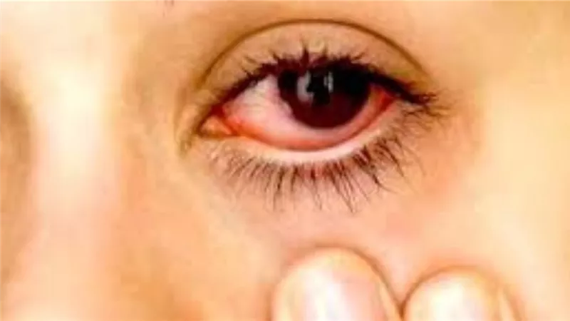 هل ينتقل فيروس كورونا عن طريق العين .. الدكتور عمرو السمرة يجيب | فيديو