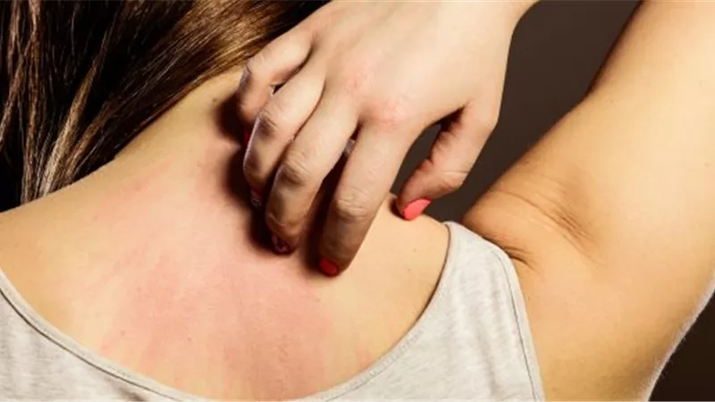 تعرف عليها..علامات جلدية جديدة تدل على الإصابة بفيروس كورونا