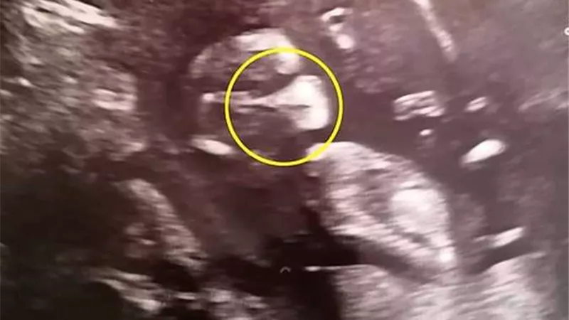 حامل مصابة بكورونا تنشر صورة جنينها يرتدي قناعًا للوجه.. ما القصة؟ | شاهد