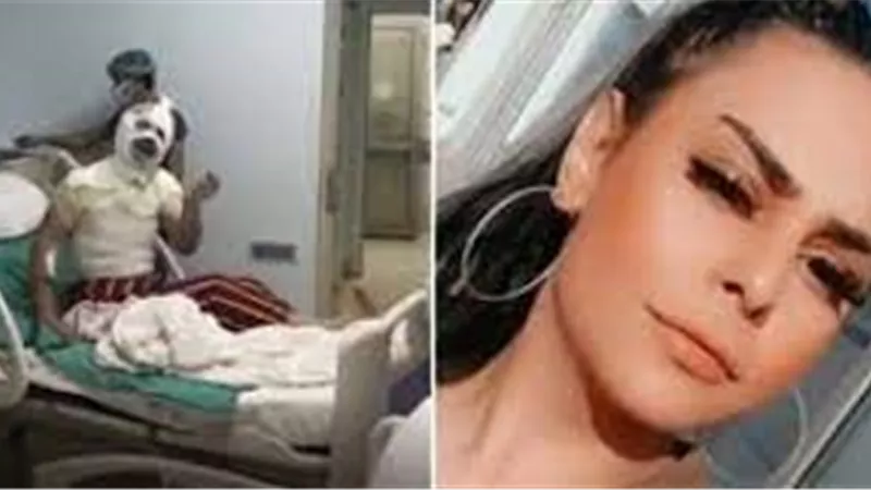 حرقها وعماها.. مراهقة تشوه وجهها وتفقد بصرها بعد هجوم حبيبها عليها