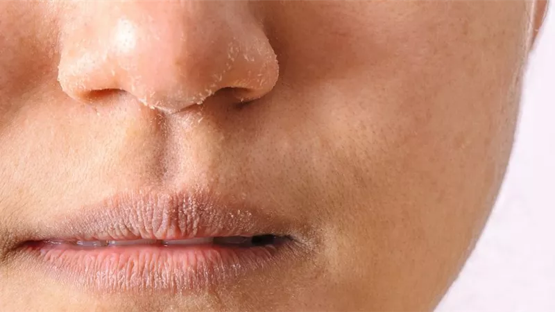 فوائدها مذهلة..7 وصفات طبيعية تخلصك من جفاف البشرة أثناء الصيام