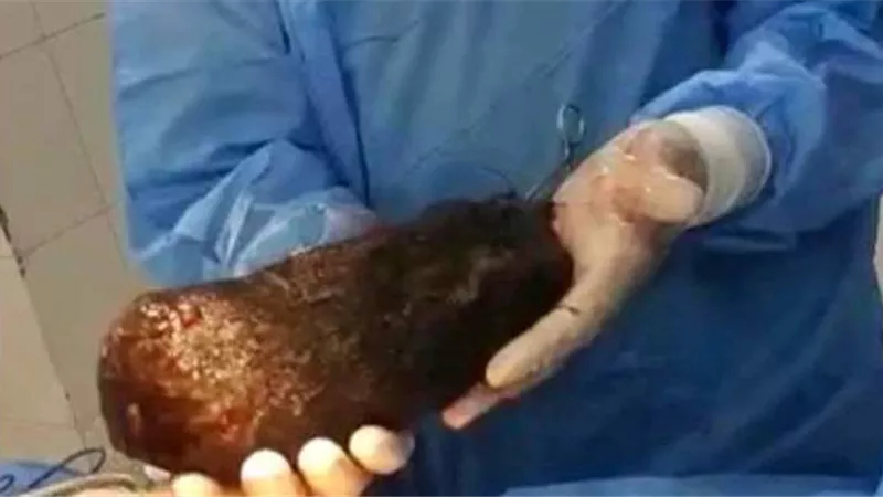 لن تصدق.. استخراج لُفافة شعر تزن 3 كيلو من معدة شاب في مطروح 