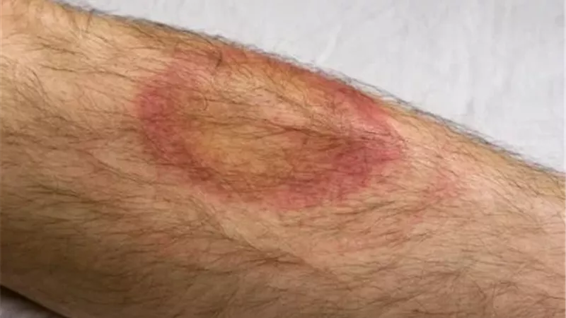 لدغته قاتلة.. عدو جديد يهاجم البريطانيين يسبب الشلل والنوبات القلبية