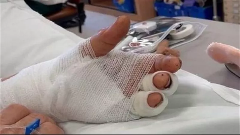 بعد أشهر من قطعها.. يد رجل تعود للحياة مرة أخرى