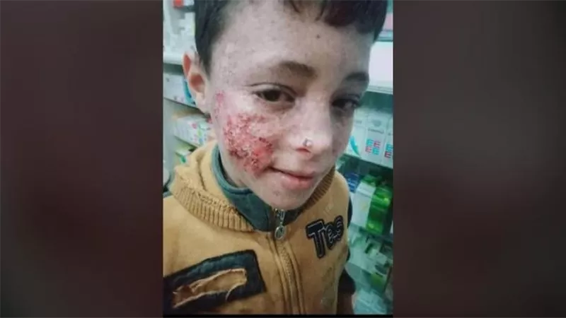 «محروم من رؤية الشمس».. طفل يعاني من ورم يشوه وجهه ووالده يتخلى عنه 