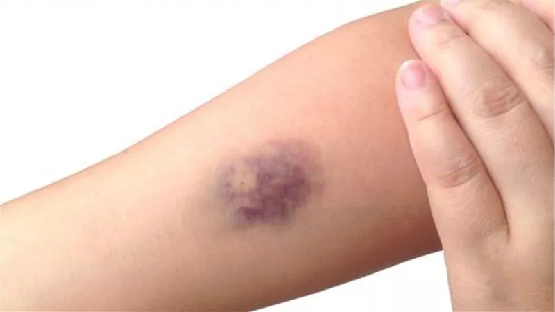 تعرف على سبب ظهور بقع زرقاء على الجسم..«زعل» ولا مرض خطير؟