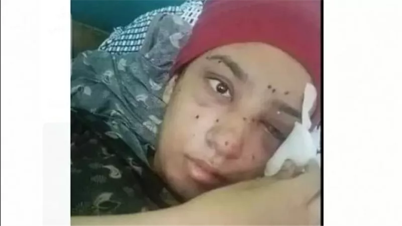 كانت بتدافع عن طفل.. فتاة تفقد عينها اليمنى بسبب خرطوش في خناقة