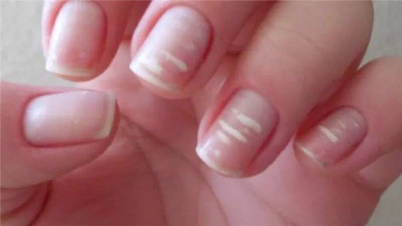 لن تتوقعها.. 5 علامات في الأظافر تشير إلى إصابتك بهذه الأمراض