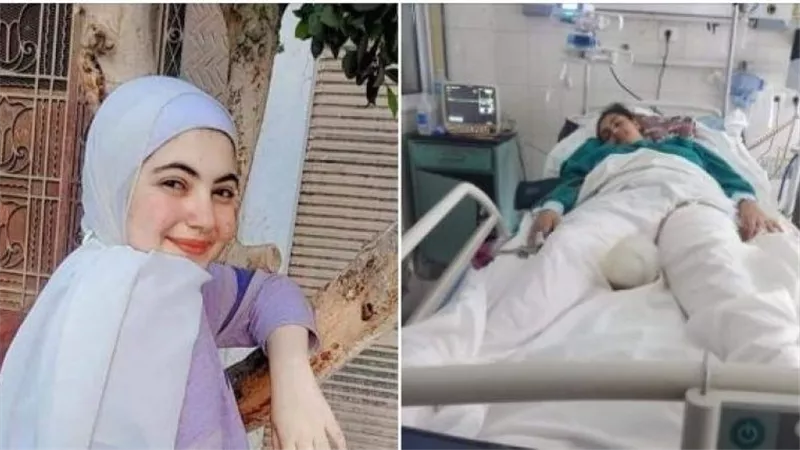  محتاجة جلد من ميت.. مأساة طفلة بين الحياة والموت بسبب «تريلا»