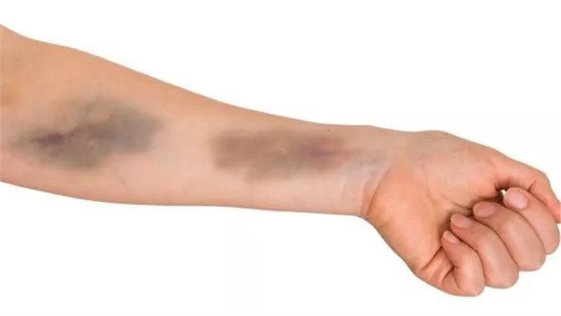اذهب للطبيب فورًا إذا ظهرت هذه الأنواع من الكدمات المجهولة على جسمك