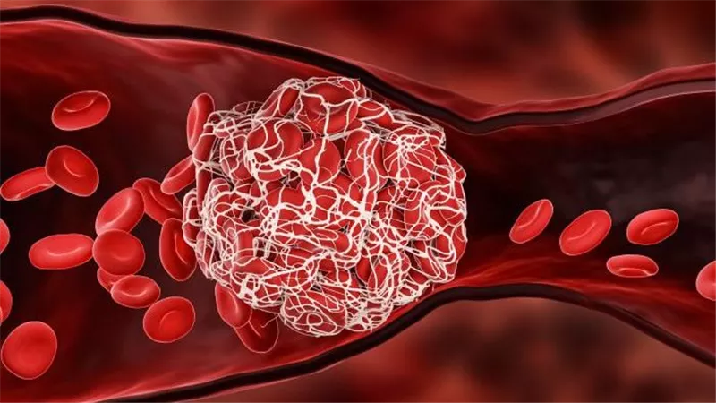 احذرها..5 أطعمة قد تمنع الدم من الحركة وتسبب جلطات دموية خطيرة