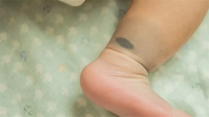 مؤشر للإصابة بمرض خطير..أسباب ظهور بقع زرقاء في الجسم عند الأطفال | فيديو 