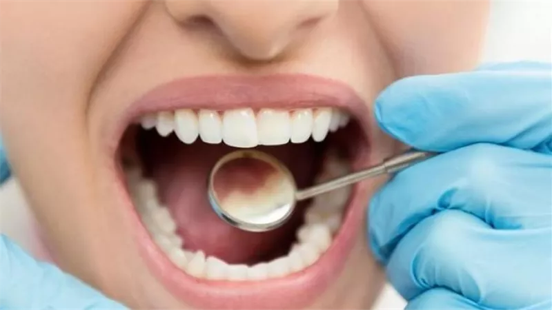  منها حمض النشويات.. طبيبة تحذّر من عادات يومية تدمّر الأسنان