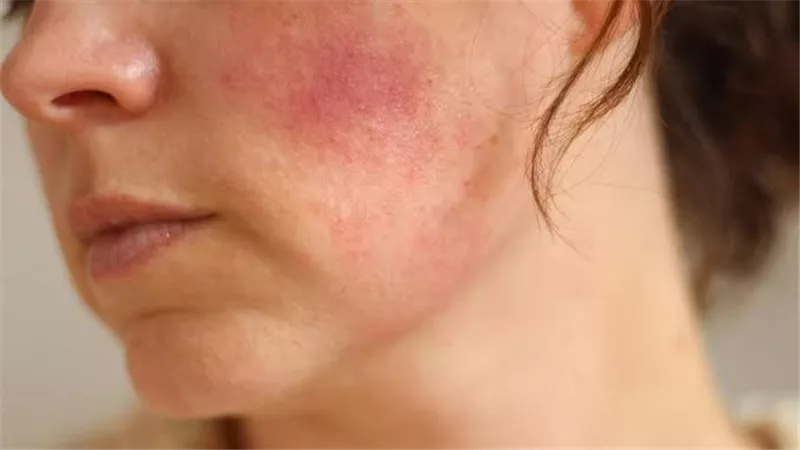 خد بالك..أسباب ظهور البقع الحمراء على الجسم