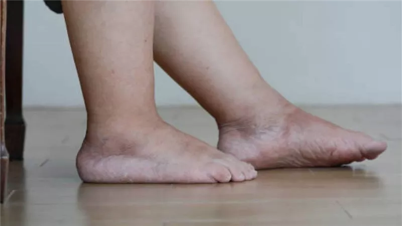 احذر.. هذه الأعراض تنذر بمتلازمة القدم السكري