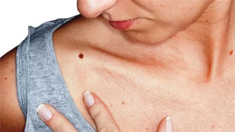 في هذه الحالة توجه للطيب فورًا..8 علامات تحذيرية تكشف الإصابة بسرطان الجلد