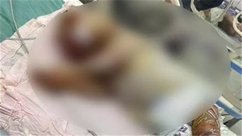 جسمها كله متغطي بالشمع.. قصة المولودة العجيبة في مستشفى المحلة وسبب حالتها