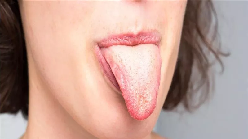 لن تتوقع.. هذا ما تشير إليه البقع البيضاء على اللسان