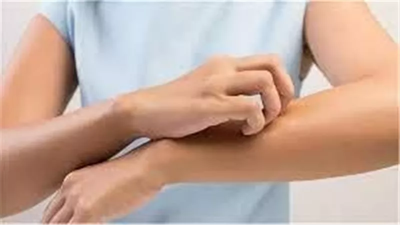  بعد تسجيل إصابات.. مرض جلدي خطير ومعدي يهدد البشر وهذه أعراضه