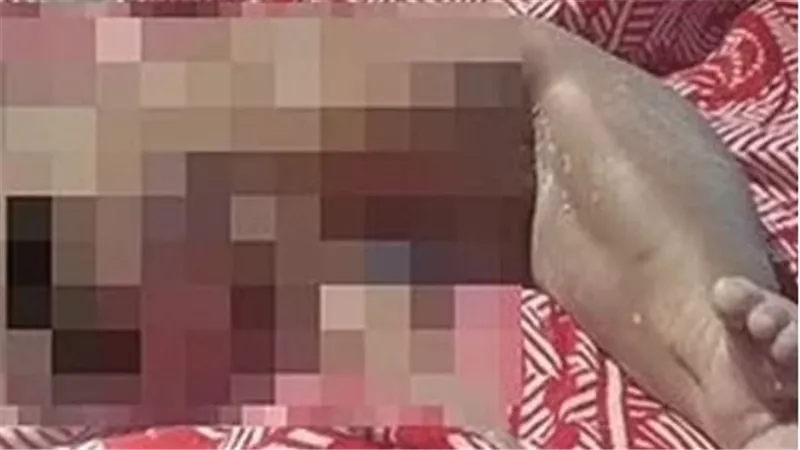 ما القصة؟.. طفل على هيئة حورية البحر يثير دهشة الأطباء