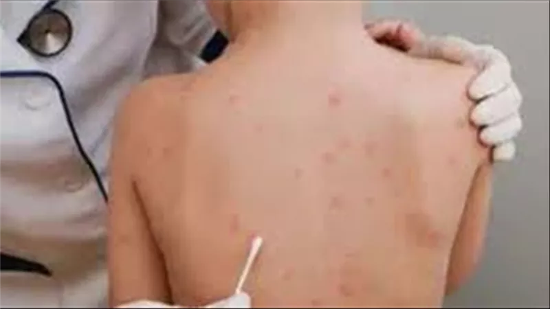بعدما أثار الذعر.. هل جدري القردة أشد فتكًا من فيروس كورونا؟