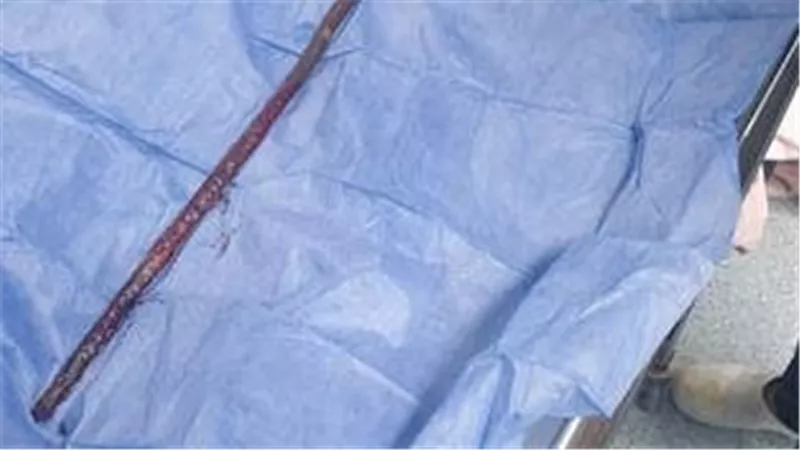 نفذ من الناحية التانية.. استخراج سيخ حديد اخترق فخذ طفل في بني سويف 
