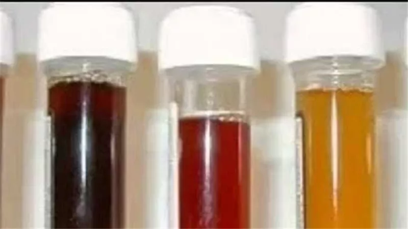 يشبه الكولا.. لون «البول» يخبرك بمرض خطير 